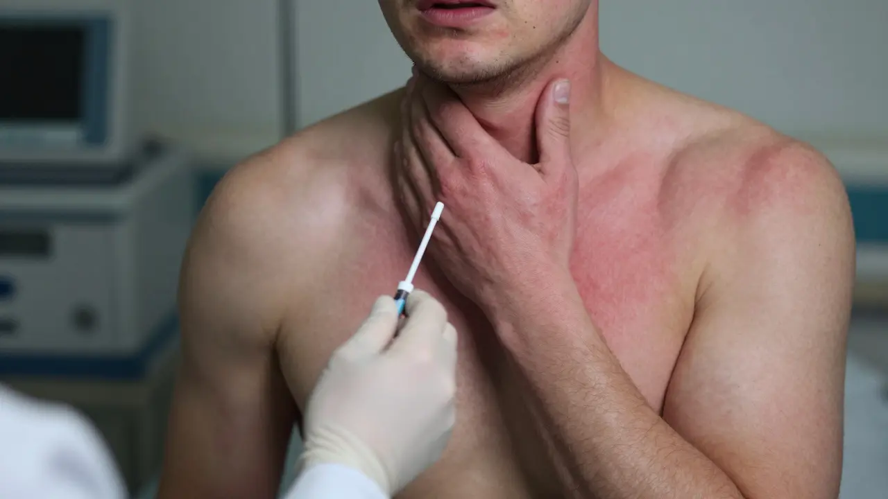 Jak se projevuje spála u dospělých - příznaky, rizika a co dělat